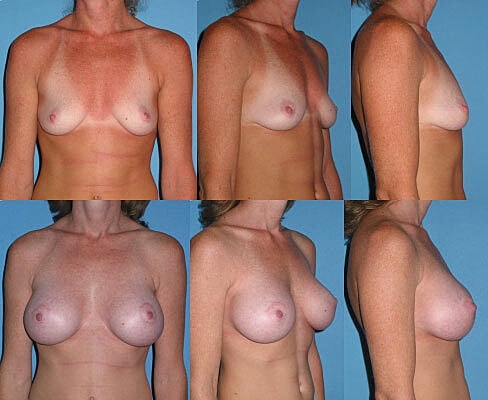 Breast Augmentation Before & After