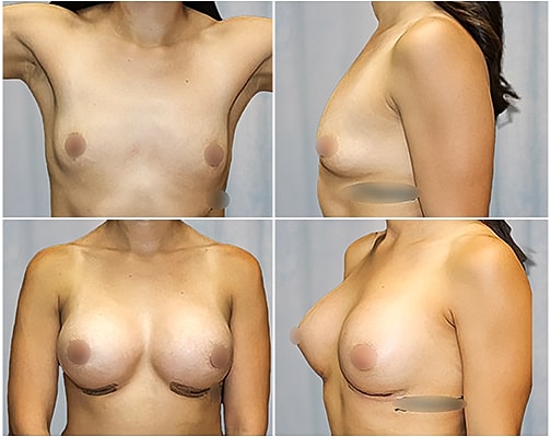 Breast Augmentation Before & After