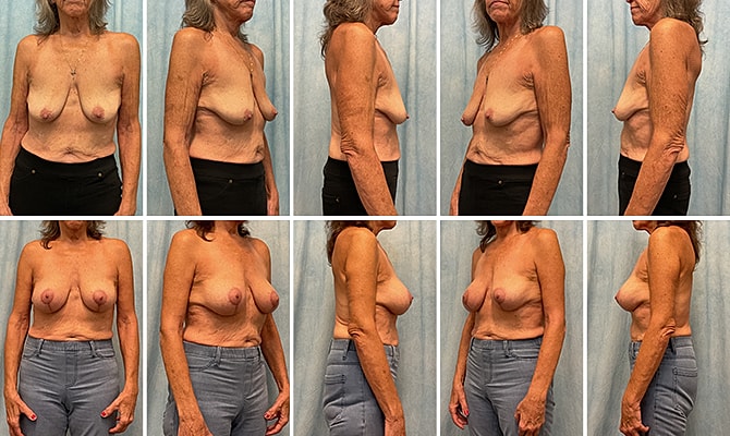Breast Augmentation Before & After