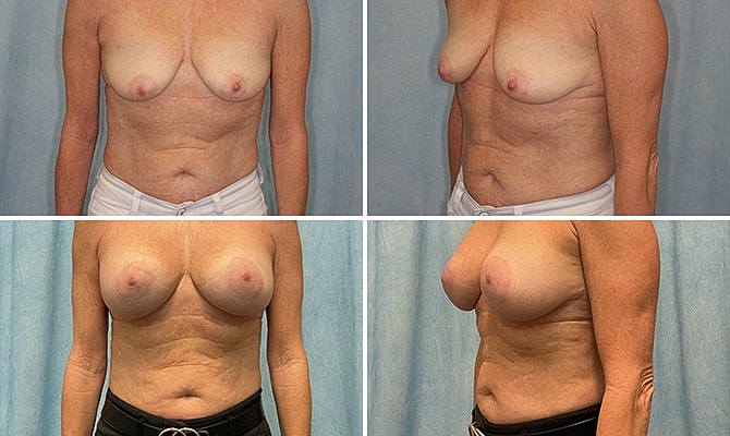 Breast Augmentation Before & After