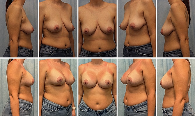 Breast Augmentation Before & After