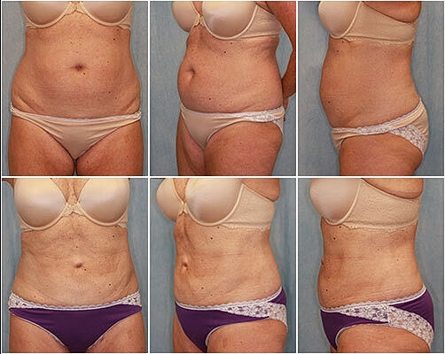 Liposuction Before & After