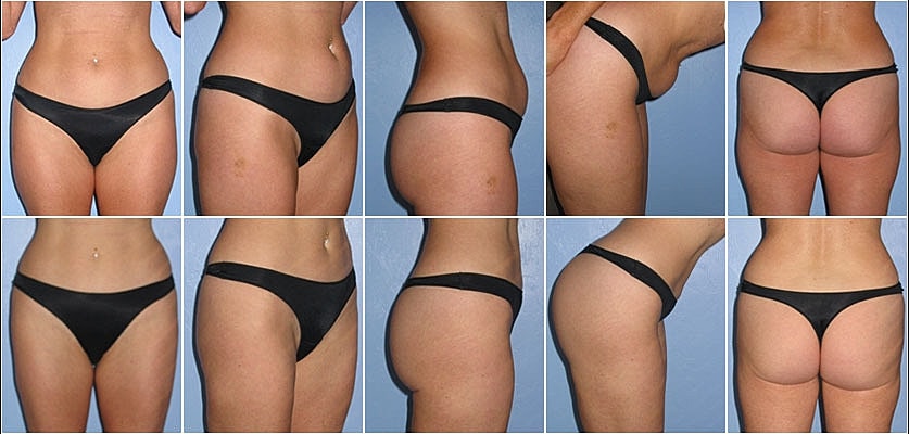 Liposuction Before & After