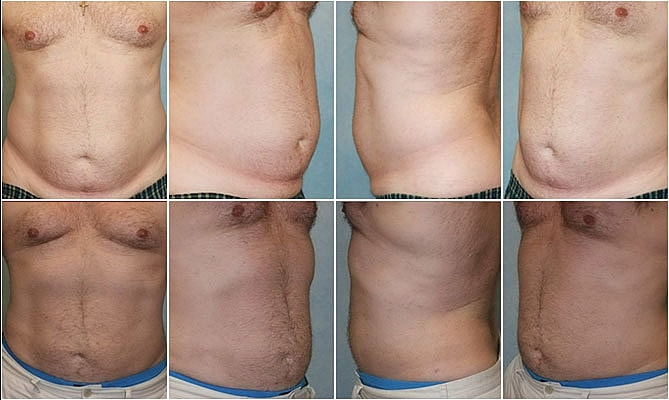 Liposuction Before & After