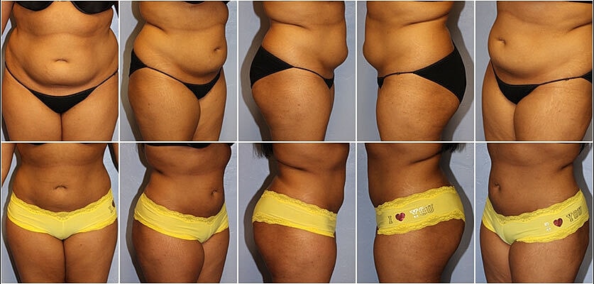 Liposuction Before & After