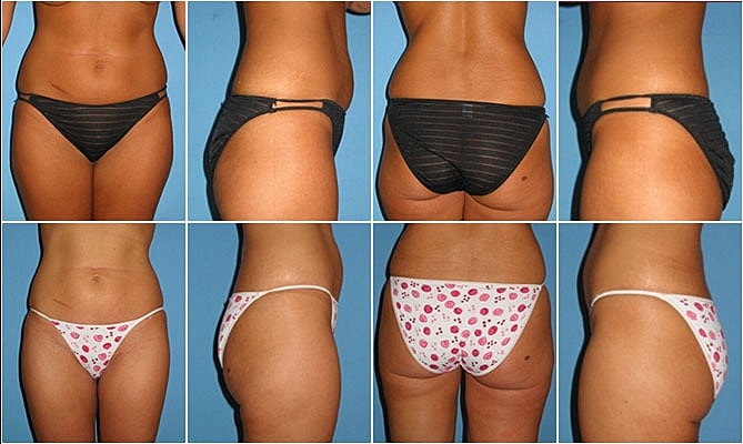 Liposuction Before & After