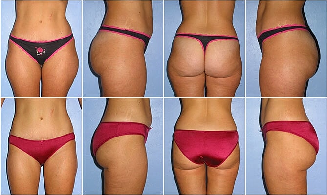 Liposuction Before & After