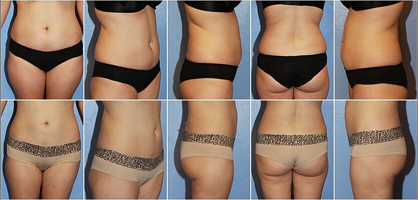 Liposuction Before & After