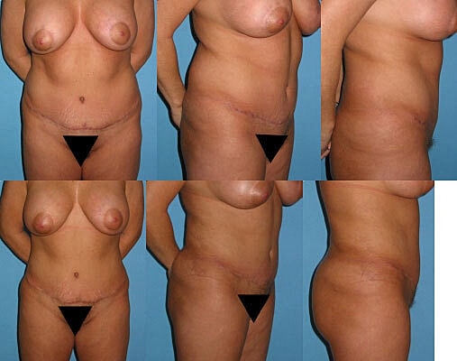 Liposuction Before & After