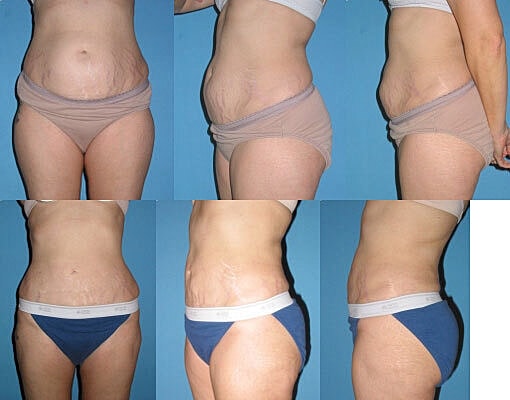 Liposuction Before & After