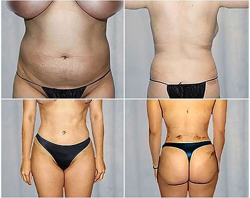 Liposuction Before & After