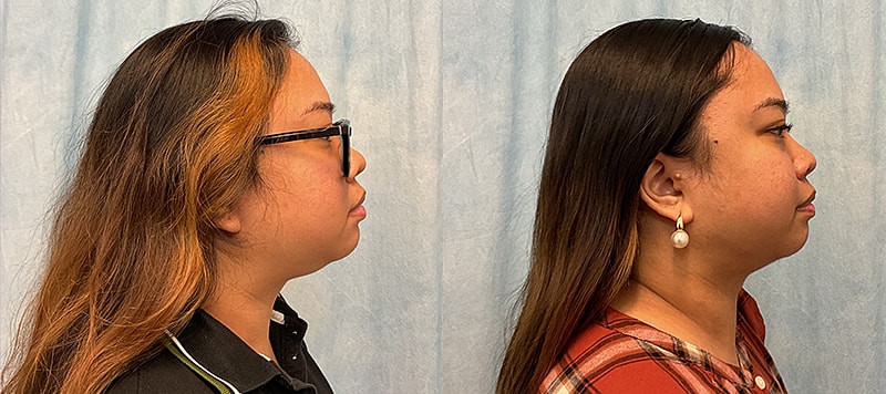 Liposuction Before & After