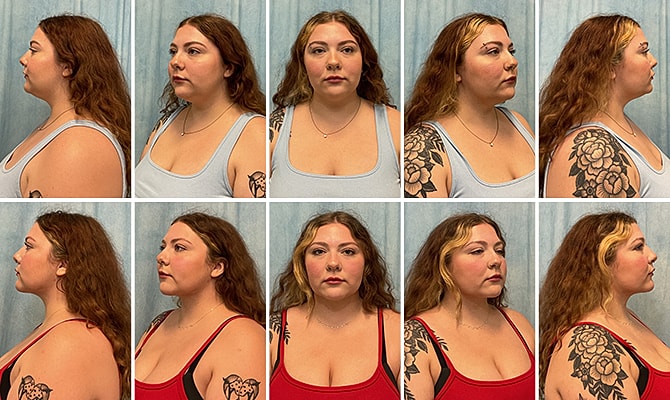 Liposuction Before & After
