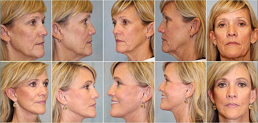 Facelift Before & After