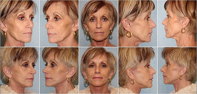 Facelift Before & After