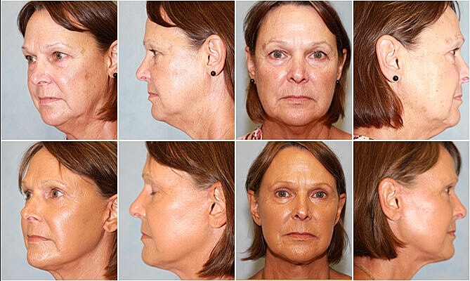 Facelift Before & After