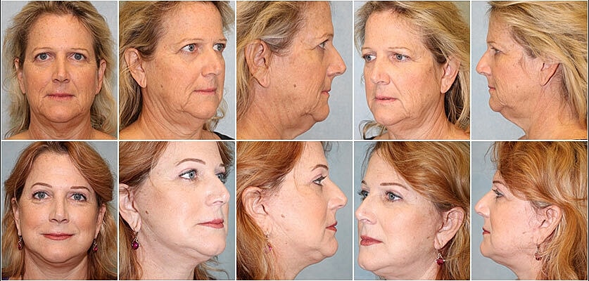 Facelift Before & After