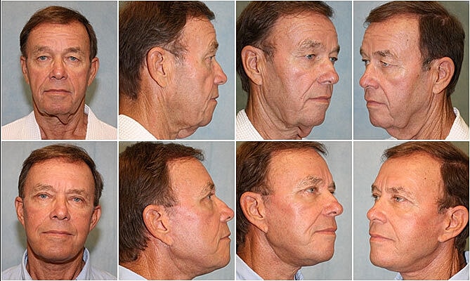 Facelift Before & After