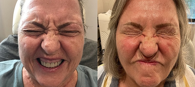Botox Before & After