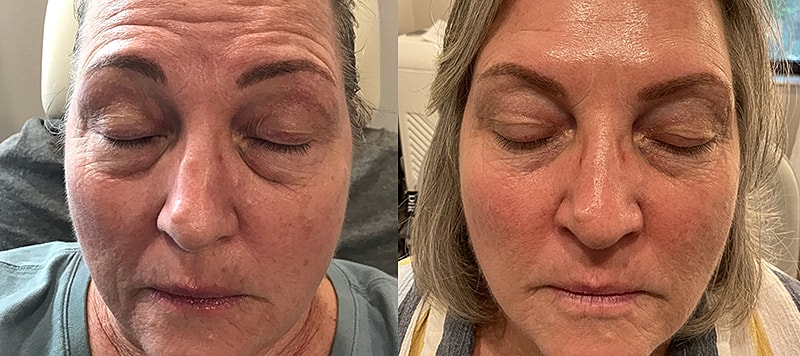 Botox Before & After