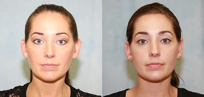 Otoplasty Before & After
