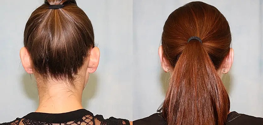 Otoplasty Before & After