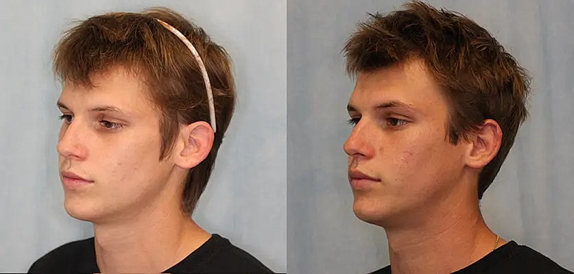 Otoplasty Before & After
