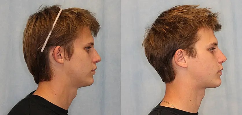 Otoplasty Before & After