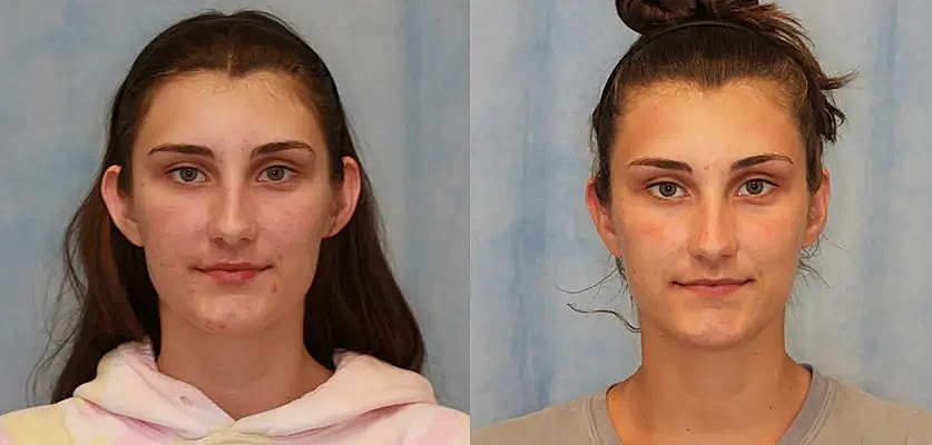 Otoplasty Before & After