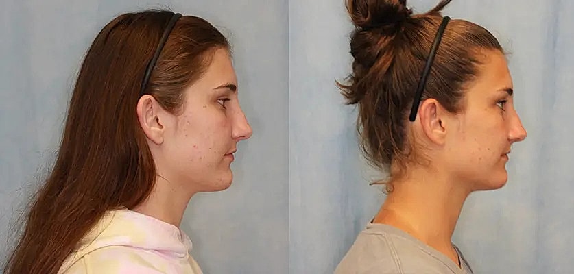 Otoplasty Before & After