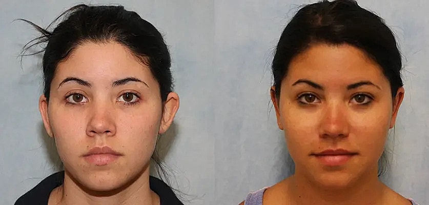 Otoplasty Before & After