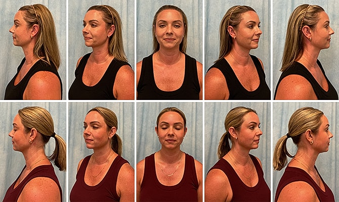 Otoplasty Before & After