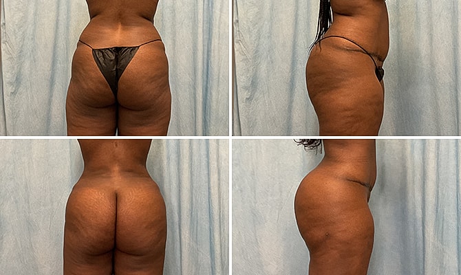 Fat Transfer Before & After