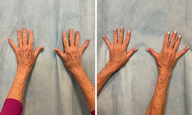 Fat Transfer Before & After