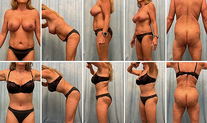 Fat Transfer Before & After