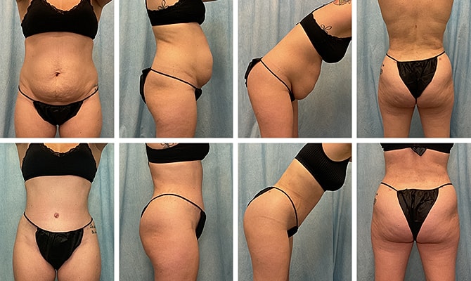 Fat Transfer Before & After