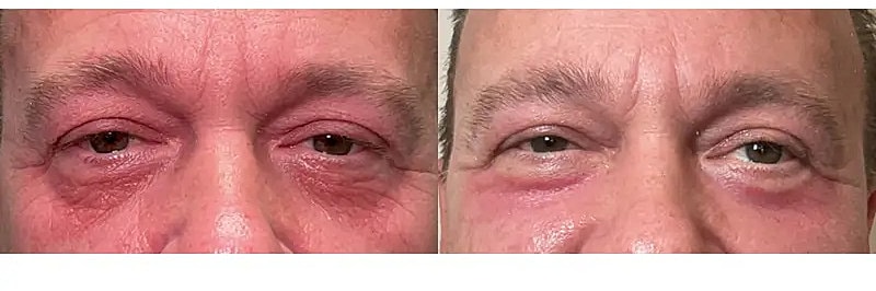 Co2 Laser Before & After