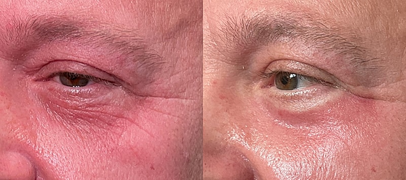 Co2 Laser Before & After