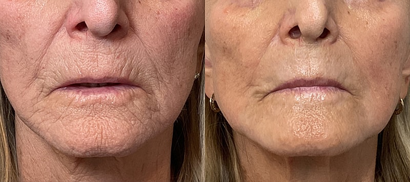 Co2 Laser Before & After