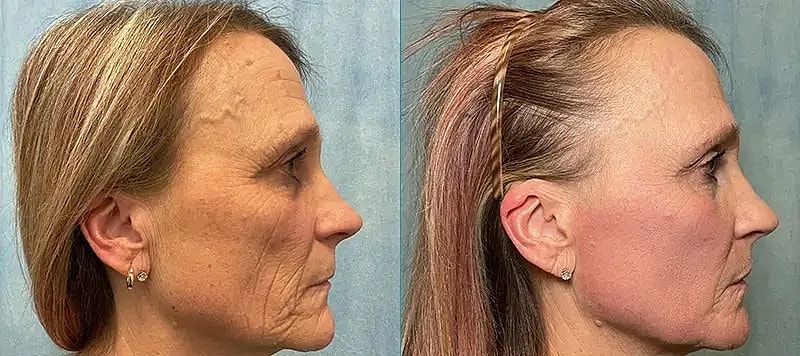 Co2 Laser Before & After
