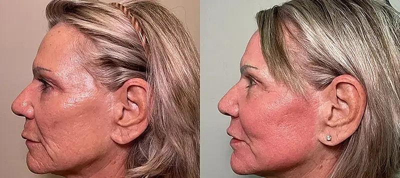 Co2 Laser Before & After