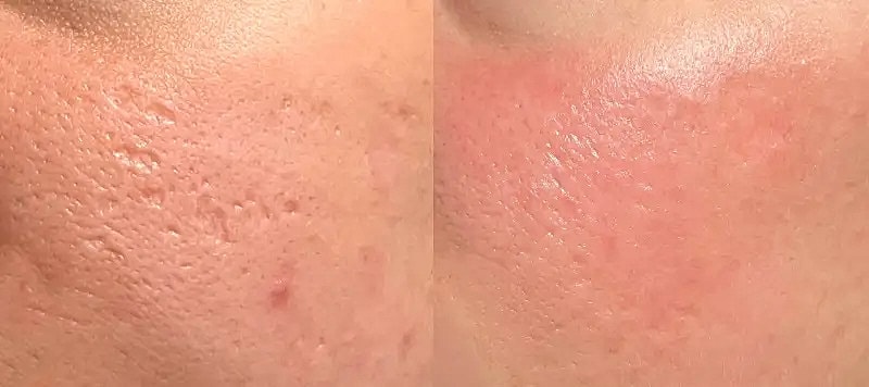 Co2 Laser Before & After