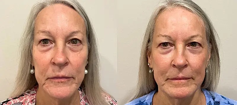 Co2 Laser Before & After
