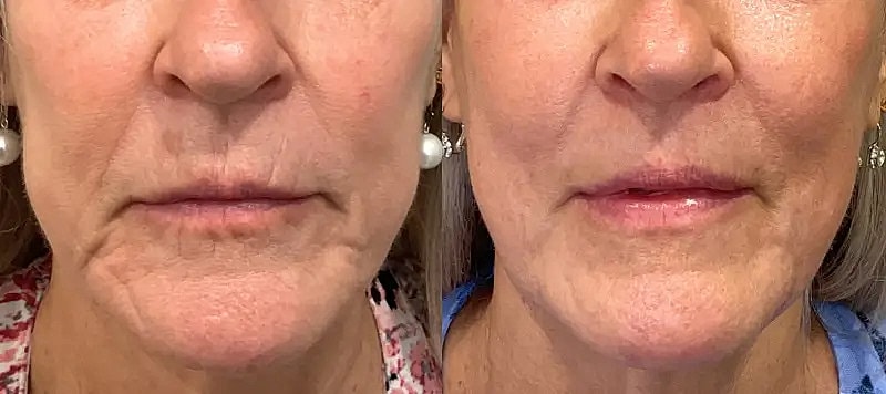 Co2 Laser Before & After