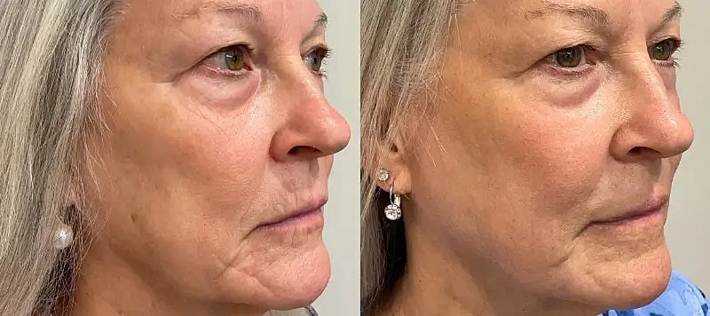 Co2 Laser Before & After