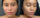 skin care treatment