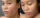 skin care treatment