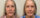 Co2 laser treatment
